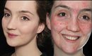 Skin Transformation Makeup (How Acne Adverts Work)