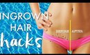INGROWN HAIR HACKS | GET RID of INGROWN HAIRS | Paris & Roxy