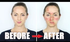 HOW TO MAKE ACNE Makeup Tutorial  / HalloweenXTRA 3 (2017)