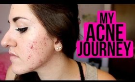 My Acne Journey (Proactiv/Epiduo/What Worked & What Didn't) | tewsimple