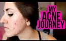 My Acne Journey (Proactiv/Epiduo/What Worked & What Didn't) | tewsimple