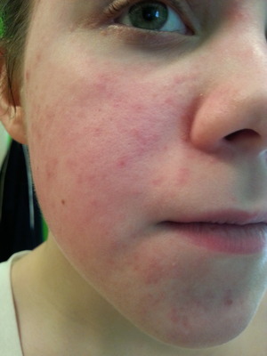 allergic reaction on face