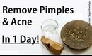 Get Rid of Pimples &  Acne - in 1 Day! * (Indian Beauty Secrets) - by SuperWowStyle