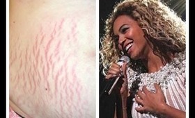 How to Get Rid of Stretch Marks + Beyonce Mrs Carter Philly concert 2013 clips!!!! PhillyGirl1124 on YouTube