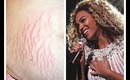 How to Get Rid of Stretch Marks + Beyonce Mrs Carter Philly concert 2013 clips!!!! PhillyGirl1124 on YouTube