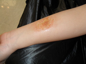 Diseased Skin