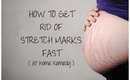 How to get rid of STRETCH MARKS FAST (At home remedy)