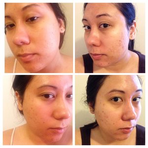 After 2 months of using Paula's choice vitamin c serum every day - here is what my acne scars look like