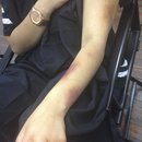 Spfx Arm Bruises