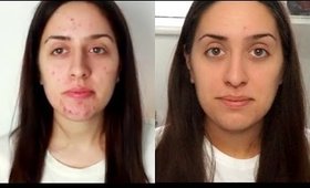 How To Get Rid of Acne | Quick and Simple