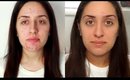 How To Get Rid of Acne | Quick and Simple