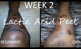 Lactic Acid:Fading Surgery Scars | Week 2 | Demo + Result Pics