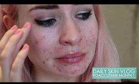 Roaccutane Daily Skin Vlog - Month 1