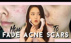 TESTING BANISH FOR 2 MONTHS TO FADE MY ACNE SCARS | MissElectraheart