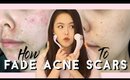 TESTING BANISH FOR 2 MONTHS TO FADE MY ACNE SCARS | MissElectraheart