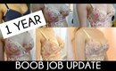 1 YEAR POST BREAST AUGMENTATION | MY BOOB JOB IN KOREA