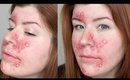 FX Makeup Series: Acne