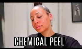 My Chemical Peel Experience | Clearing Acne & Hyper-pigmentation