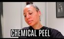 My Chemical Peel Experience | Clearing Acne & Hyper-pigmentation
