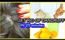 In 20 Minutes How To Clear DANDRUFF & ITCHY SCALP Remedy | SuperPrincessjo