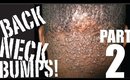 BACK NECK BUMPS! (Pt 2: Eat This, Not That!)