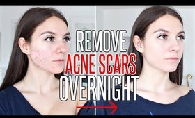 How To Get Rid Of ACNE SCARS OVERNIGHT !!