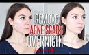 How To Get Rid Of ACNE SCARS OVERNIGHT !!