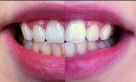 How to whiten your teeth at home quickly, (20 minutes)!