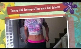 Tummy Tuck Journey- A Year and a Half Later!!!