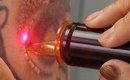 How Does Laser Tattoo Removal Work?