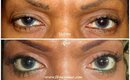 Eyelid Surgery (Blepharoplasty) 6 Month Update with Photos