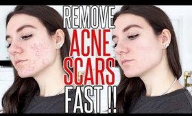 How To Get Rid Of ACNE SCARS FAST !!