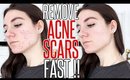 How To Get Rid Of ACNE SCARS FAST !!