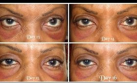 Blepharoplasty /Eyelid Surgery/ Ethnic/ African American Part 3