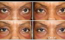 Blepharoplasty /Eyelid Surgery/ Ethnic/ African American Part 3