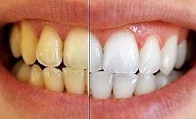How to: Teeth Whitening  With SALT! _ Teeth Whitening Home Remedy | SuperWowStyle Prachi