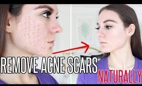 How To REALLY Get Rid of Acne Scars NATURALLY !!!