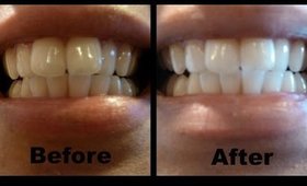 How I Whiten My Teeth at Home │ Teeth Whitening Before & After w/ Smile Brilliant │ + GIVEAWAY!