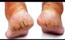 Cracked Heels Home Remedy | How to Get Rid of Cracked Feet At Home DIY  | SuperWowStyle Prachi