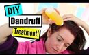 Natural DIY Dandruff Treatment! How To Remove Itchy, Flaky Scalp At Home!