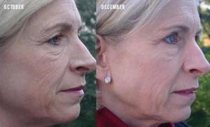 Order Amp Md Anti-Aging to get rid of wrinkles