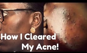 Skin Update: How I Got Rid of My Acne (A Miracle)