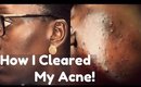 Skin Update: How I Got Rid of My Acne (A Miracle)
