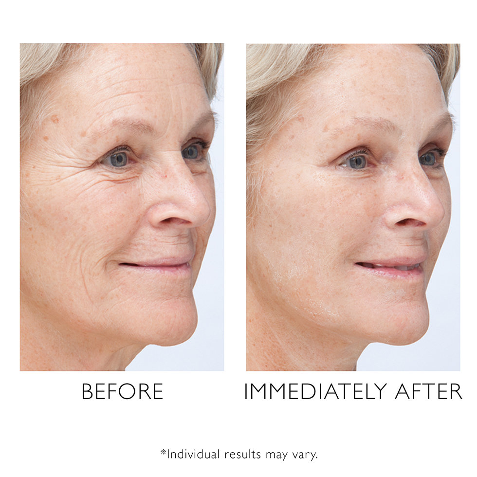 Peter Thomas Roth Instant FIRMx Before & After image
