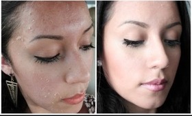 BEFORE AND AFTER- MICRODERMABRASION " PMD Antes y Despues