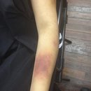 Spfx Arm Bruise