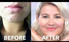 How To Cure Acne Naturally | Fast & Cheap | Milabu