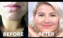 How To Cure Acne Naturally | Fast & Cheap | Milabu