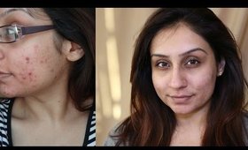 THIS WORKS - Skin care routine for acne prone skin Rose Hip Acne.Org || Makeup With Raji