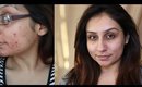 THIS WORKS - Skin care routine for acne prone skin Rose Hip Acne.Org || Makeup With Raji